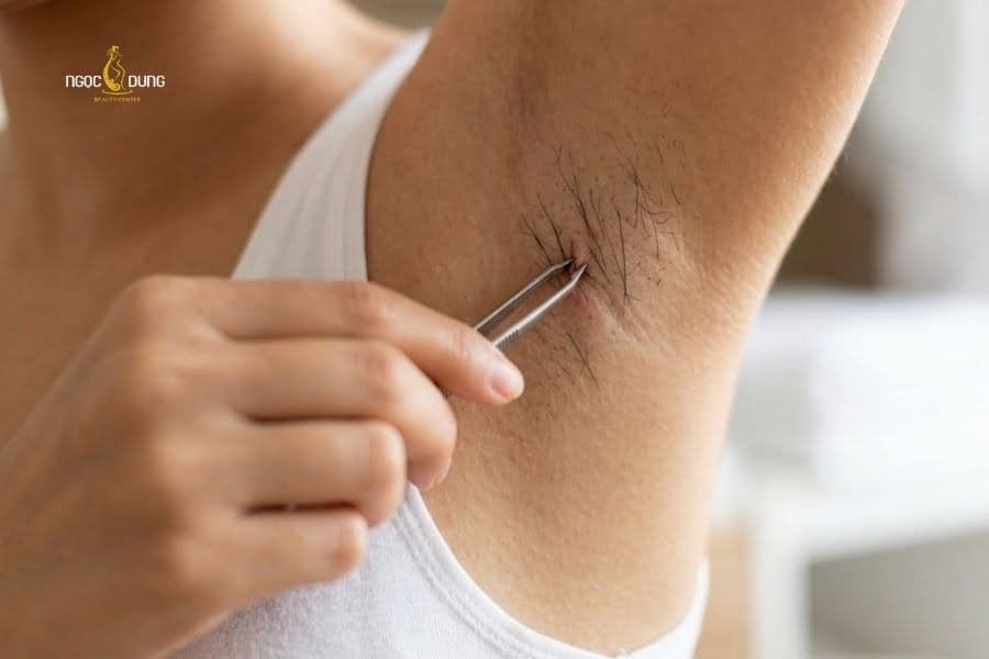 Cách trị da nách sần sùi sau khi nhổ lông hiệu quả nhanh 6 Nhổ lông nách thường xuyên làm tổn thương nang lông, từ đó làm da nách sần sùi