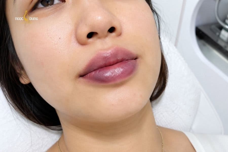 Phun môi bị bầm tím thường chỉ xuất hiện 1-2 ngày đầu sau phun