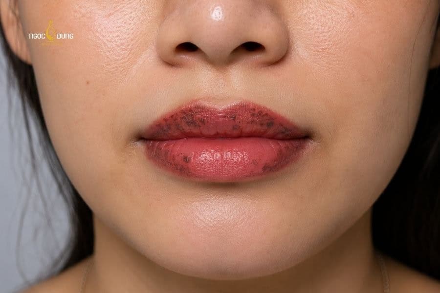 Phun môi bị đốm đen: Nguyên nhân và cách khắc phục 3 Xử lý thâm chưa triệt để cũng dễ gây ra tình trạng phun môi bị đốm đen