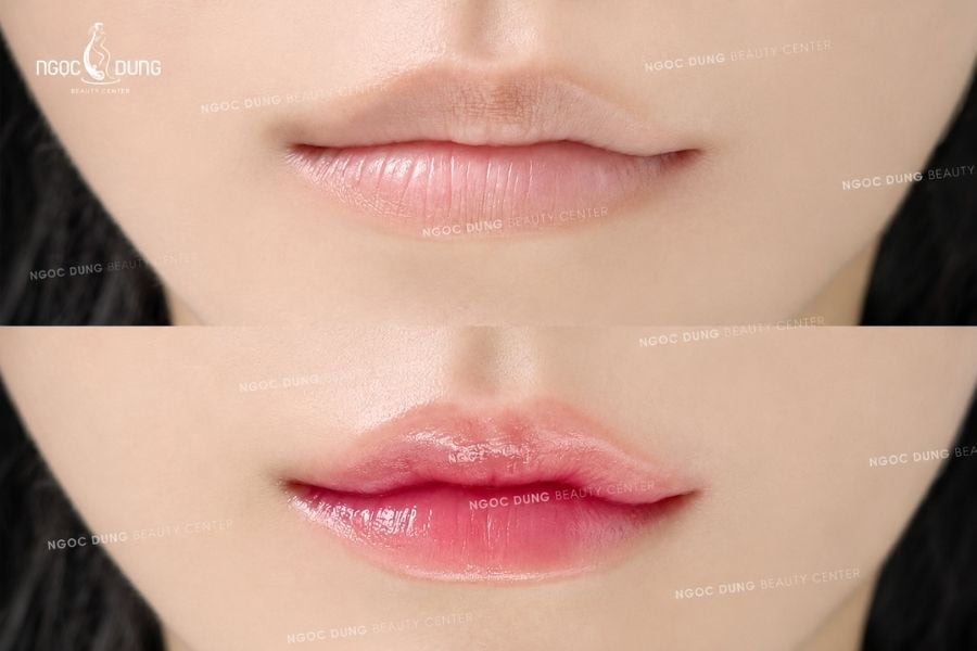 Có nên phun môi không? Ưu nhược điểm và những lưu ý 5 Phun môi Silk Lips kết hợp kỹ thuật vi điểm và công nghệ dưỡng ẩm môi HA mang lại hiệu ứng môi mọng mềm mượt
