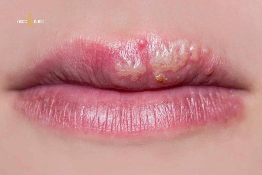 Có nên phun môi không? Ưu nhược điểm và những lưu ý 3 Phun môi tại các cơ sở không uy tín dễ có nguy cơ kích ứng và viêm da