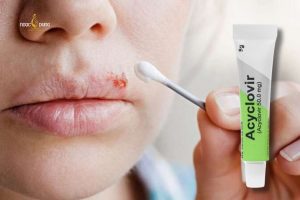 Acyclovir thường chỉ cần dùng khi môi bị kích ứng sau phun