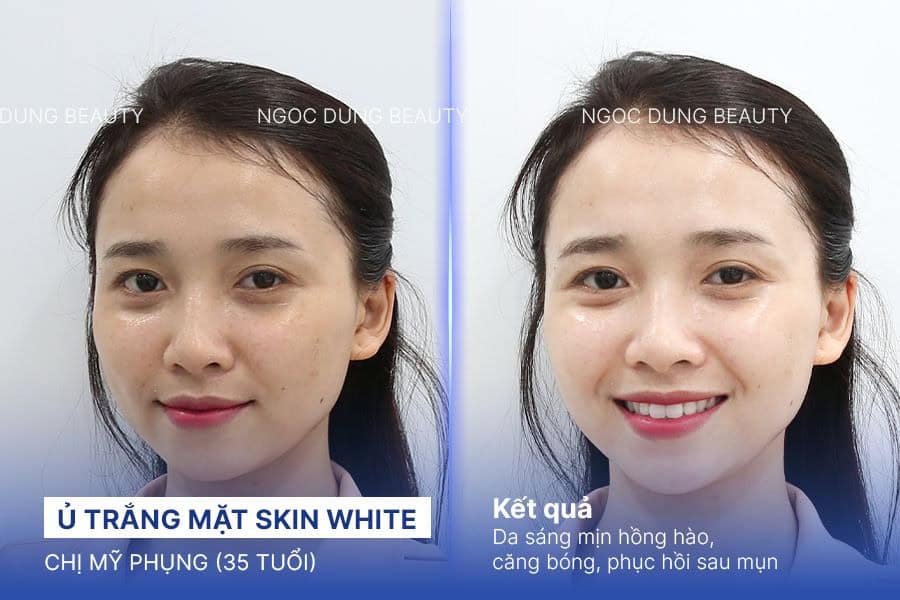 Hình ảnh trước sau của khách hàng sau khi sử dụng dịch vụ trắng da tại Thẩm mỹ viện Ngọc Dung