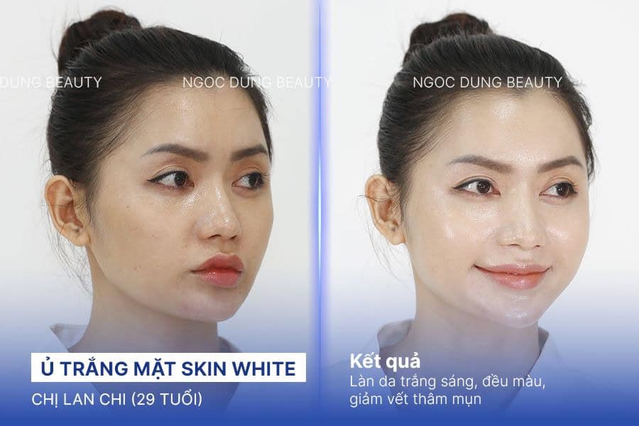 Hình ảnh trước sau của khách hàng sau khi sử dụng dịch vụ trắng da tại Thẩm mỹ viện Ngọc Dung