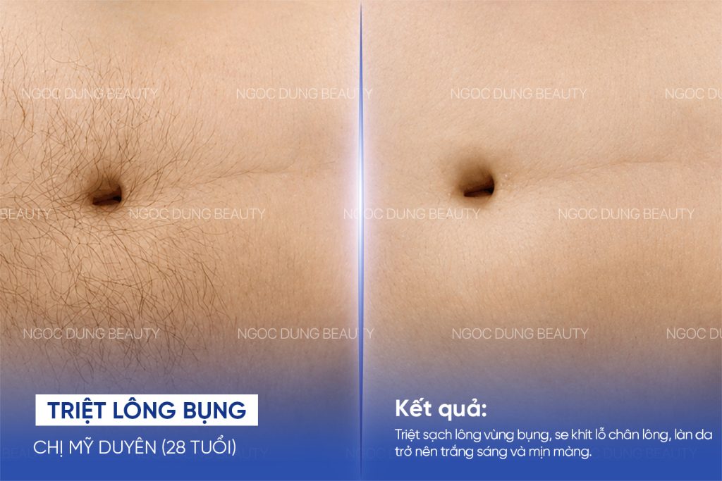Hình ảnh trước sau của khách hàng sau khi sử dụng dịch vụ triệt lông bụng tại Thẩm mỹ viện Ngọc Dung