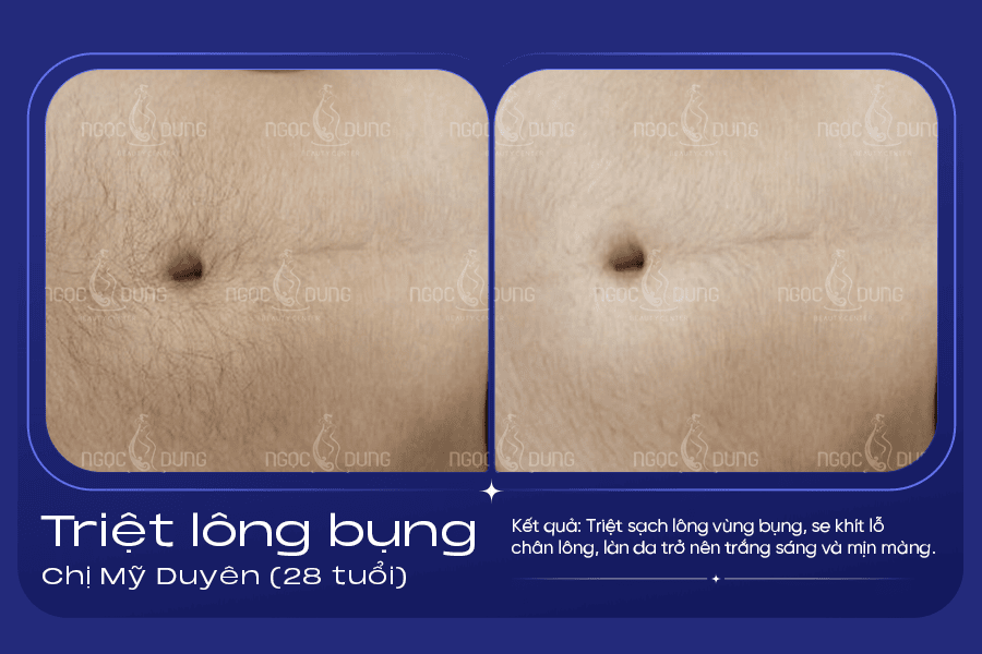 Kết quả triệt lông bụng tại Ngọc Dung