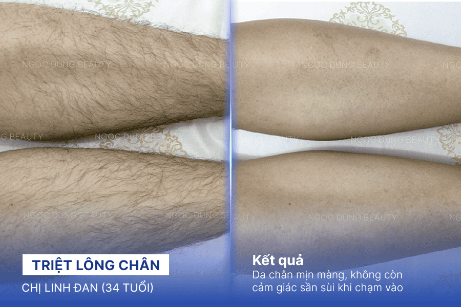 Hình ảnh trước sau của khách hàng sau khi sử dụng dịch vụ triệt lông chân tại Thẩm mỹ viện Ngọc Dung