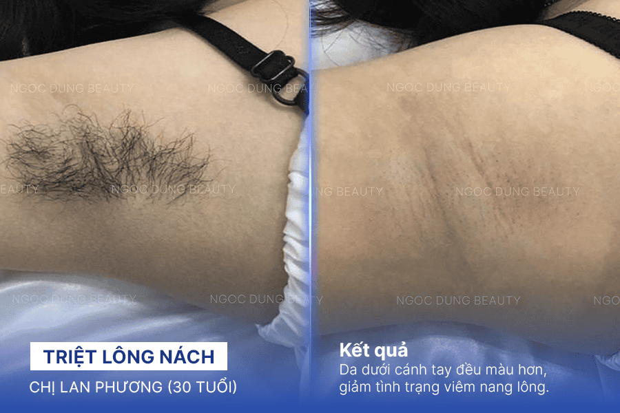 Hình ảnh trước sau của khách hàng sau khi sử dụng dịch vụ triệt lông nách tại Thẩm mỹ viện Ngọc Dung