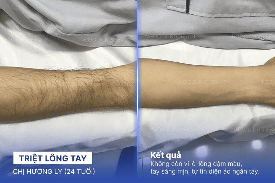 Hình ảnh trước sau của khách hàng sau khi sử dụng dịch vụ triệt lông tay tại Thẩm mỹ viện Ngọc Dung