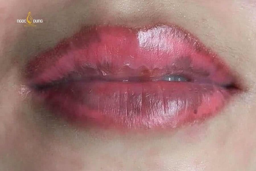 Cách vệ sinh răng miệng sau khi phun môi, lên màu đẹp 3 Vệ sinh răng miệng không đúng cách sau phun môi dễ gây ra loang lổ màu môi