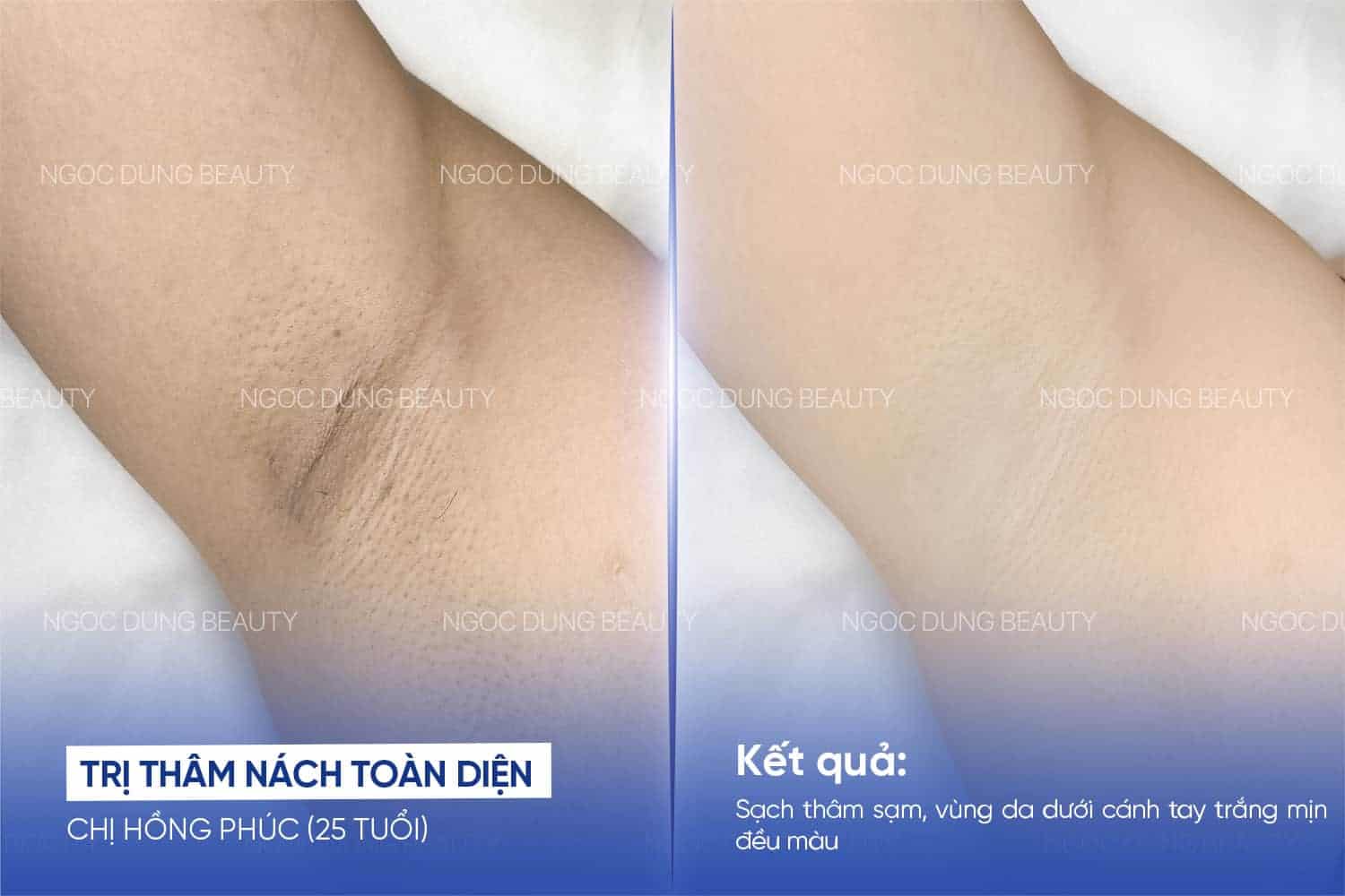 Vùng cánh sạch thâm sáng mịn sau 9 buổi trị thâm kết hợp trẻ hóa tại Ngọc Dung