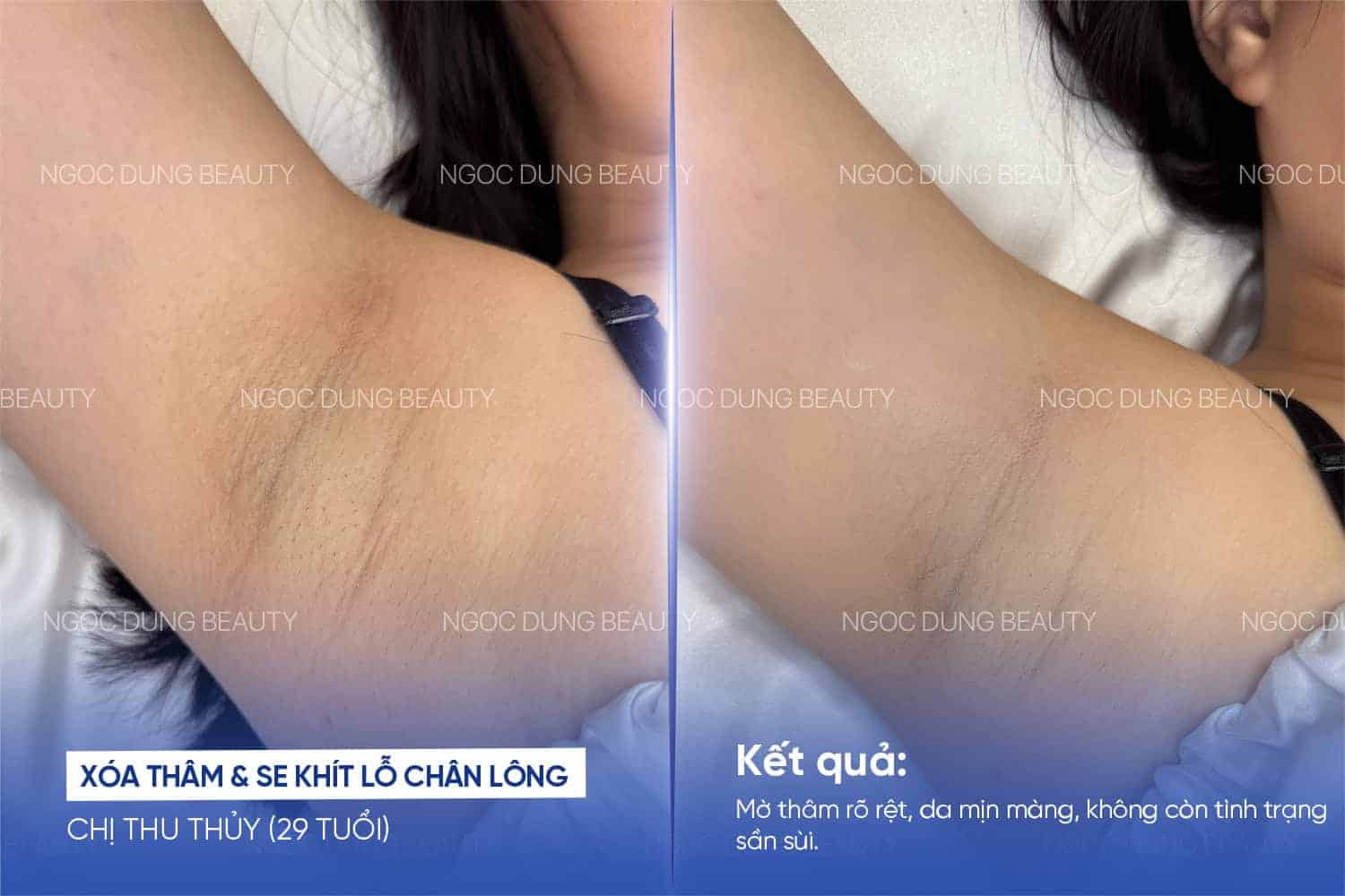 Kết quả nách sạch mịn sau 5 buổi trị thâm