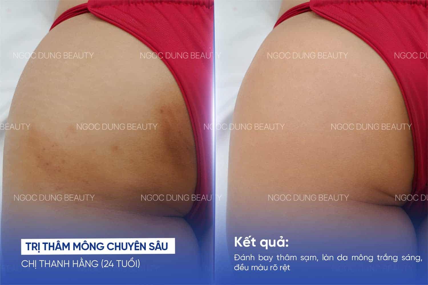 Vùng da mông sẫm màu được cải thiện rõ rệt sau liệu trình, bề mặt da trông sáng và đều màu hơn tại Ngọc Dung