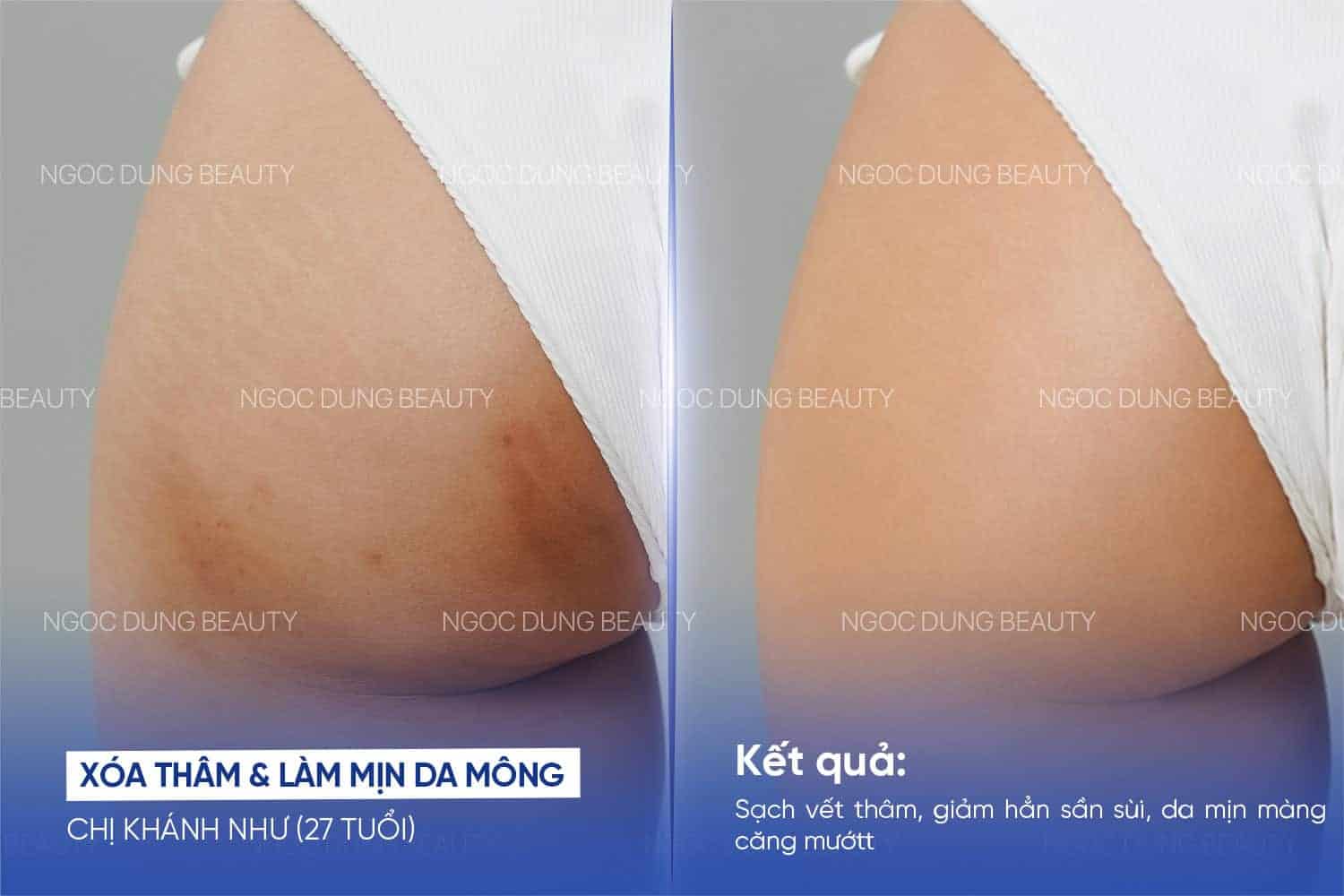 Kết quả trước – sau cho thấy vùng thâm mông giảm dần, sắc da trở nên đồng đều và mịn màng hơn sau điều trị tại Ngọc Dung