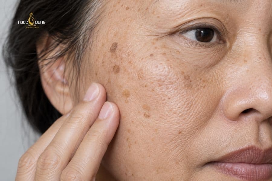 Dạ bị đồi mồi do lão hóa