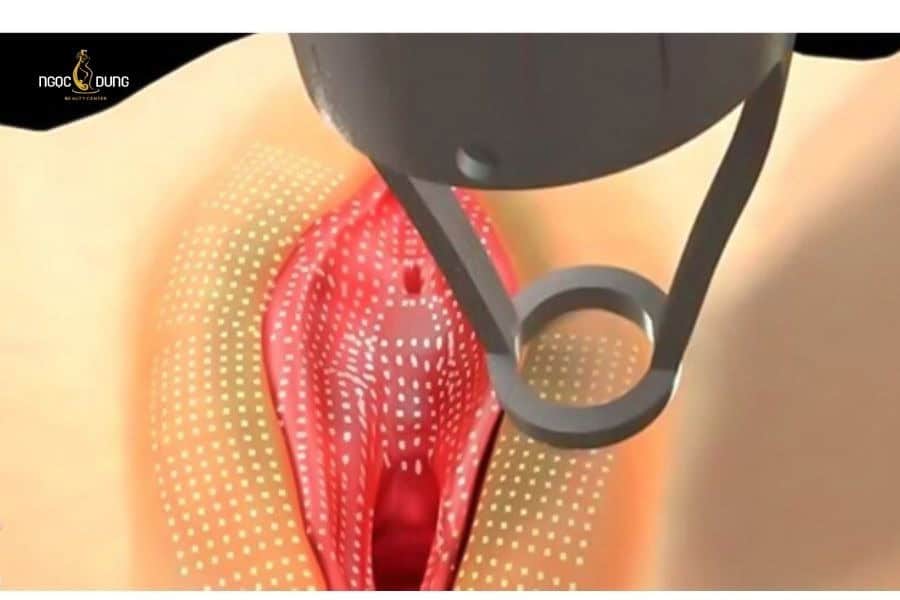 Làm hồng vùng kín bằng laser cần nhiều buổi mới thấy kết quả rõ rệt