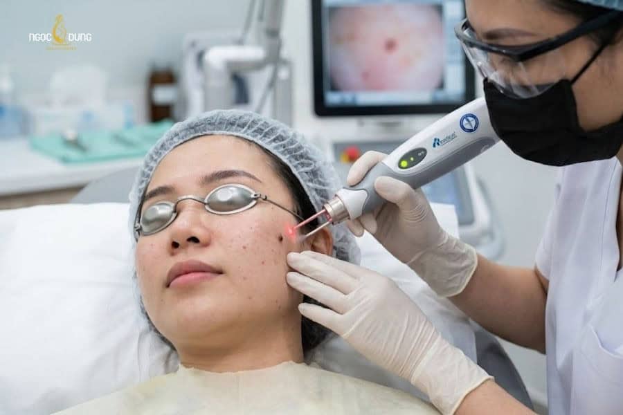 Chi phí tẩy nốt ruồi bị ảnh hưởng bởi công nghệ điều trị