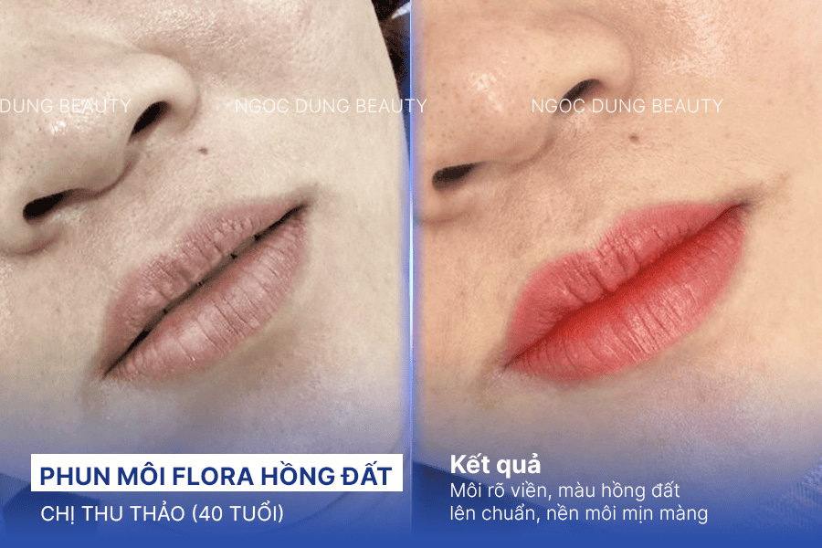 Xử lý tình trạng môi thâm triệt để chỉ với 60 phút phun môi