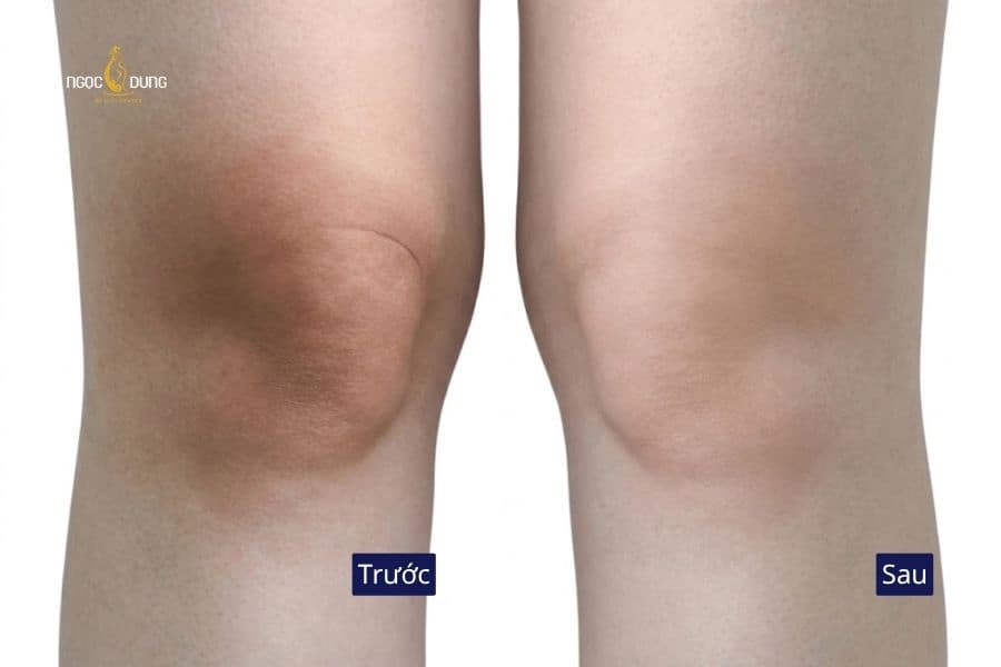Sắc da đầu gối dần lấy lại vẻ tươi sáng, mịn màng và đồng đều, hoàn thiện nét đẹp chỉn chu cho đôi chân