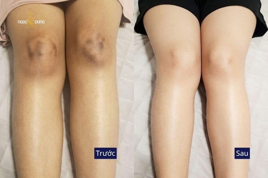 Từ vùng da sẫm màu, kém đều màu đến diện mạo sáng mịn và tinh tế hơn sau liệu trình chăm sóc tại Ngọc Dung