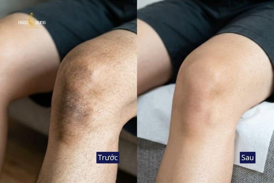 Sắc da vùng đầu gối trở nên sáng mịn, đồng đều hơn sau liệu trình chăm sóc chuyên sâu tại Ngọc Dung