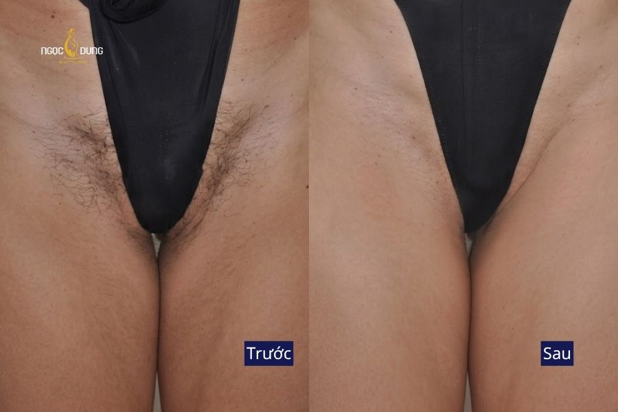 Loại bỏ phần lông rậm kém thẩm mỹ, mang lại bề mặt da vùng bikini mượt mà và thông thoáng hơn