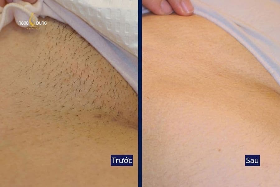 Sau triệt lông bikini tại Ngọc Dung, vùng da được chăm sóc gọn gàng hơn