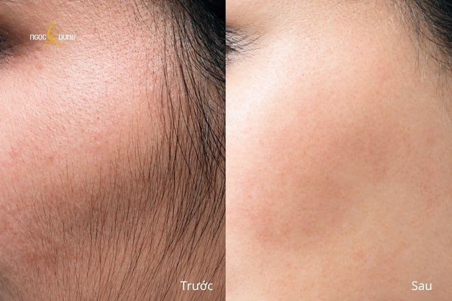 Giảm tình trạng lông mặt kém thẩm mỹ, mang lại bề mặt da mượt mà và cảm giác sạch thoáng hơn