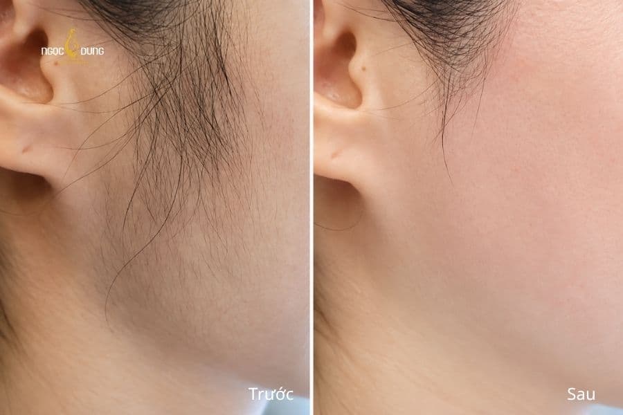 Từ bề mặt da nhiều lông tơ đến diện mạo mịn và đều hơn