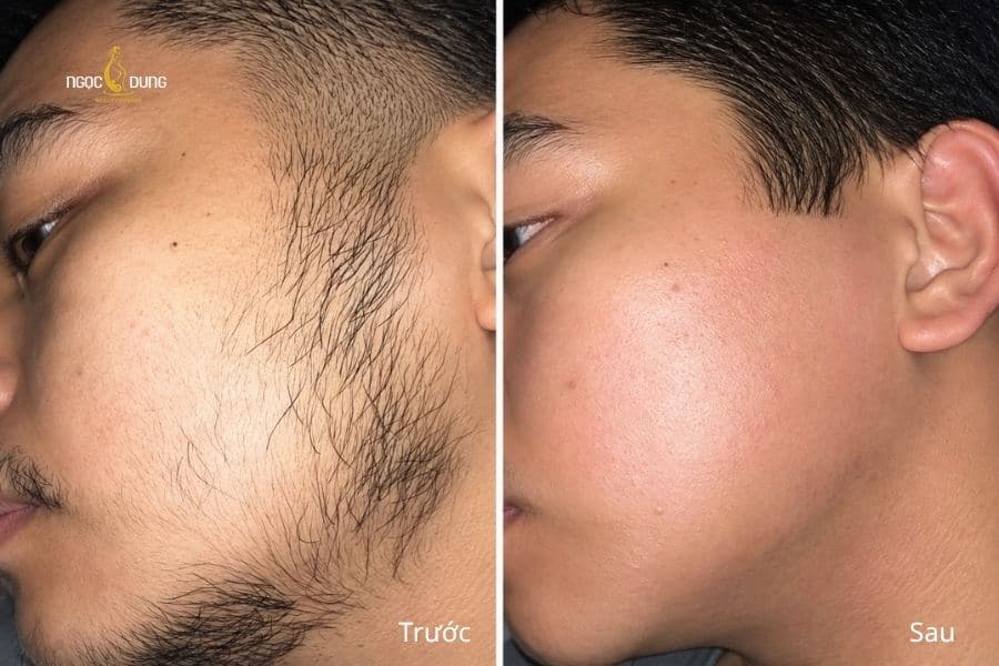 Sau triệt râu quai nón tại Ngọc Dung, đường nét gương mặt trở nên sáng và chỉn chu hơn