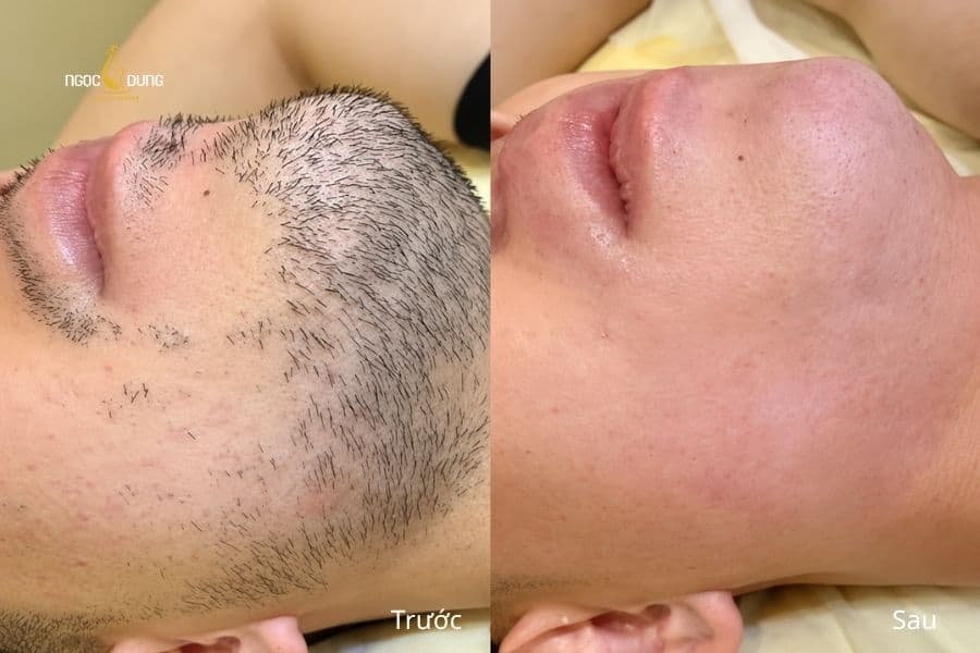 Từ vùng râu mọc dày, kém gọn gàng đến bề mặt da mịn và thông thoáng hơn sau liệu trình