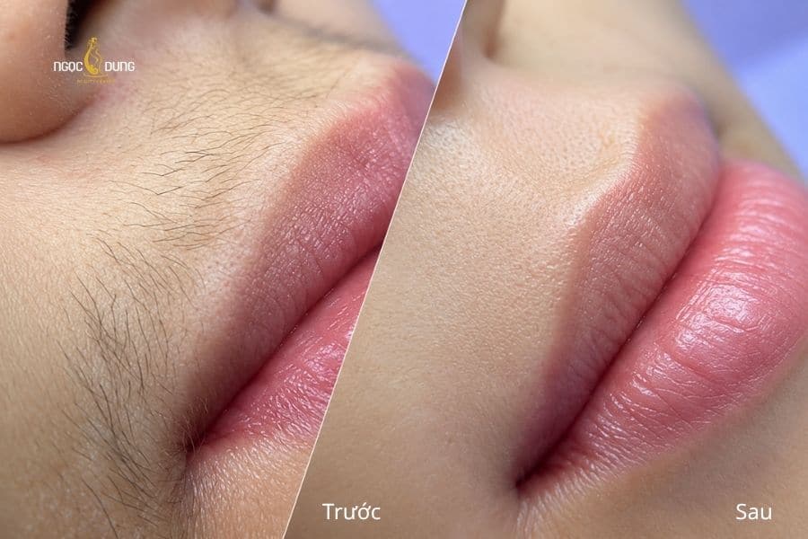 Từ vùng ria mép khá rõ đến làn da mịn và sạch hơn sau liệu trình