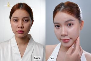 Kết quả trước và sau khi ủ trắng tại Ngọc Dung Beauty