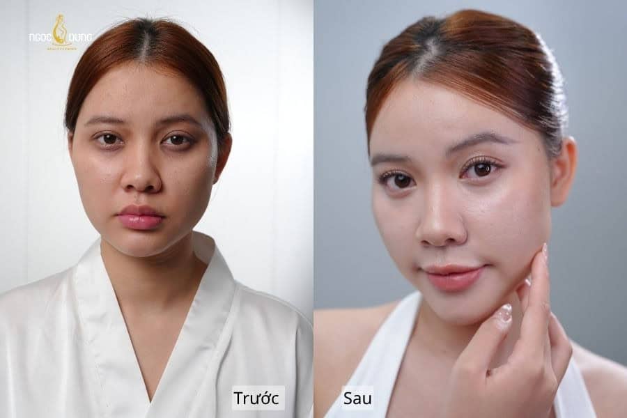 Kết quả trước và sau khi ủ trắng tại Ngọc Dung Beauty