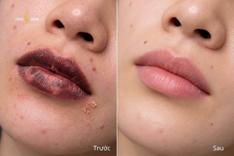 Từ sắc mực đậm, kém hài hòa đến nền môi nhẹ nhàng hơn khi xóa xăm môi tại Ngọc Dung