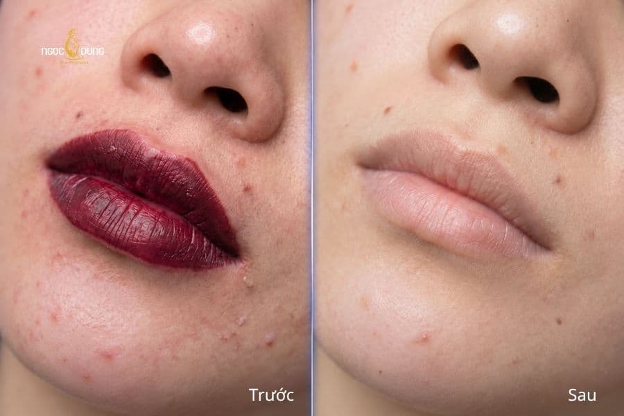 Từ sắc mực đậm, kém hài hòa đến nền môi nhẹ nhàng hơn khi xóa xăm môi tại Ngọc Dung