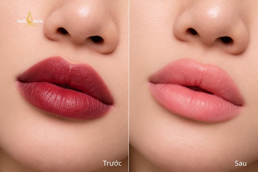 Loại bỏ nền mực cũ, trả lại sắc môi tự nhiên và hài hòa hơn sau liệu trình xóa xăm môi tại Ngọc Dung