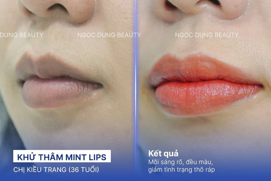 Kết quả khử thâm môi lâu năm đều màu và mềm mại