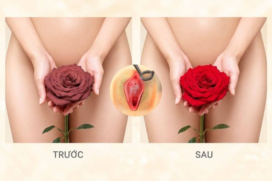 Trị thâm vùng kín bằng công nghệ laser tận dụng bước sóng sinh học để loại bỏ các sắc tố melanin