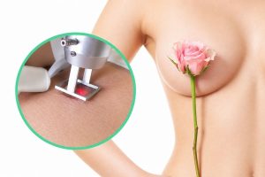 Laser giúp nhũ hoa hồng hào bằng cách tác động có chọn lọc vào các hắc sắc tố