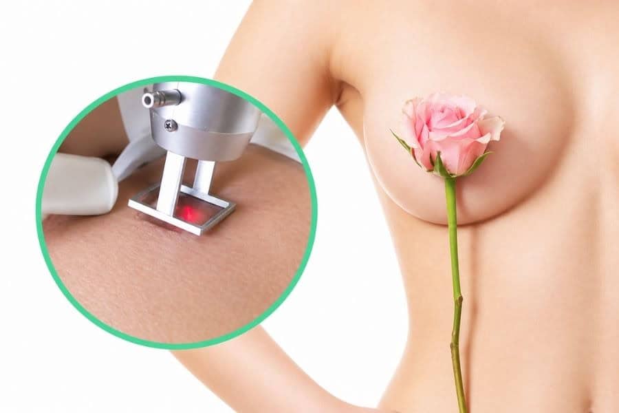 Laser giúp nhũ hoa hồng hào bằng cách tác động có chọn lọc vào các hắc sắc tố