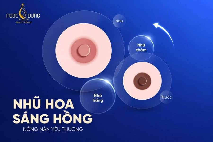 Ngọc Dung mang đến giải pháp làm hồng nhũ hoa từ công nghệ laser tân tiến chuẩn y khoa