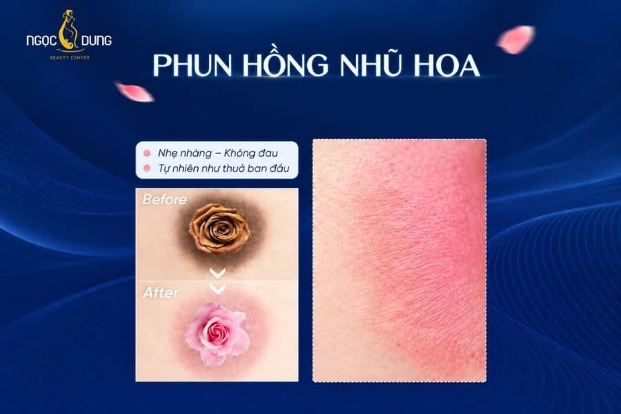 Ngọc Dung còn có giải pháp phun hồng nhũ hoa giúp bạn sở hữu kết quả như ý nhanh chóng