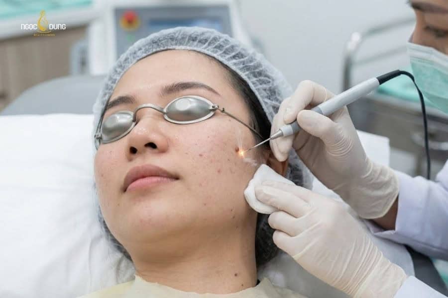 Đốt điện phù hợp với các nốt ruồi có kích thước vừa