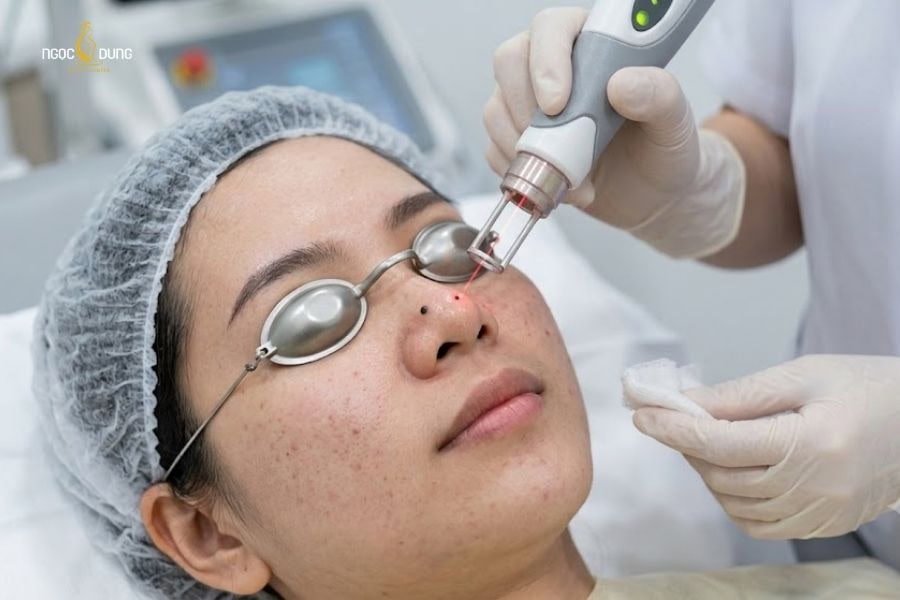 Tẩy nốt ruồi bằng laser được đánh giá là giải pháp hiệu quả và an toàn cho da  hiện nay