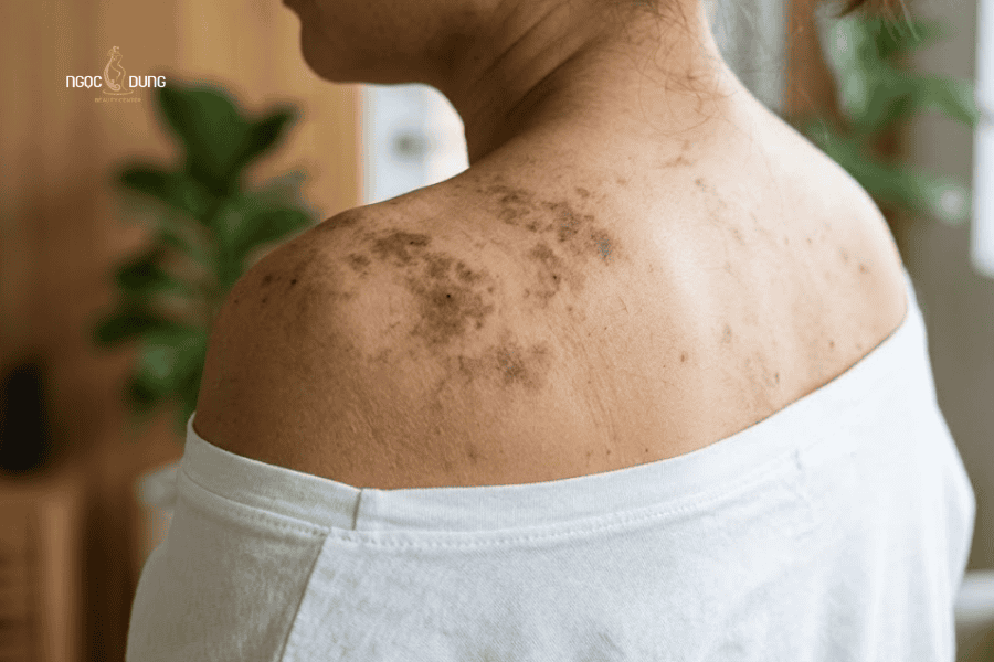 Tia UV thường là yếu tố chính gây ra tình trạng thâm body