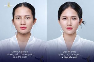 Kết quả trẻ hóa da tại Ngọc Dung