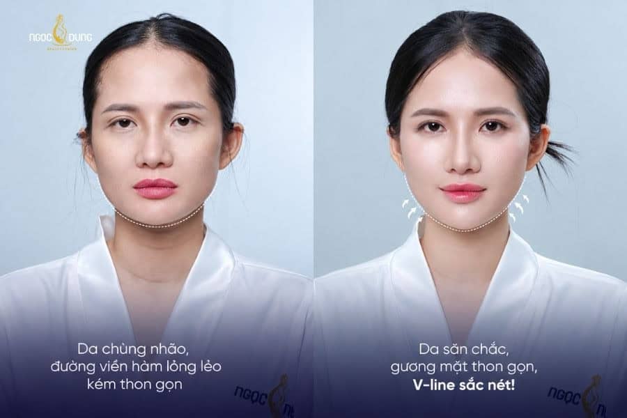 Kết quả trẻ hóa da tại Ngọc Dung