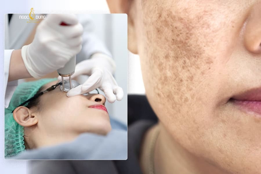 Trị nám bằng laser hiệu quả nếu bạn đi đủ phác đồ điều trị