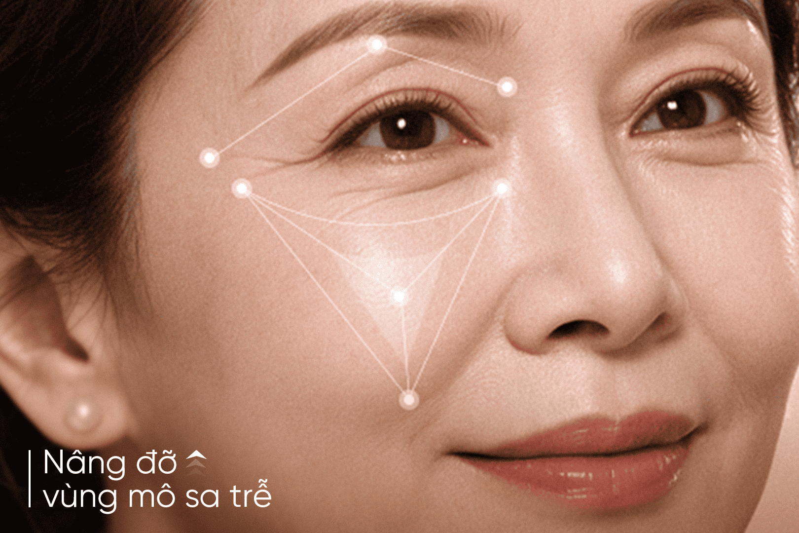 Radiesse tham gia vào quá trình tái tạo vùng mô sa trễ của gương mặt